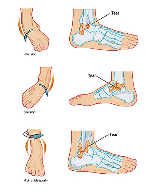 How To Fix A Sprained Ankle Quick