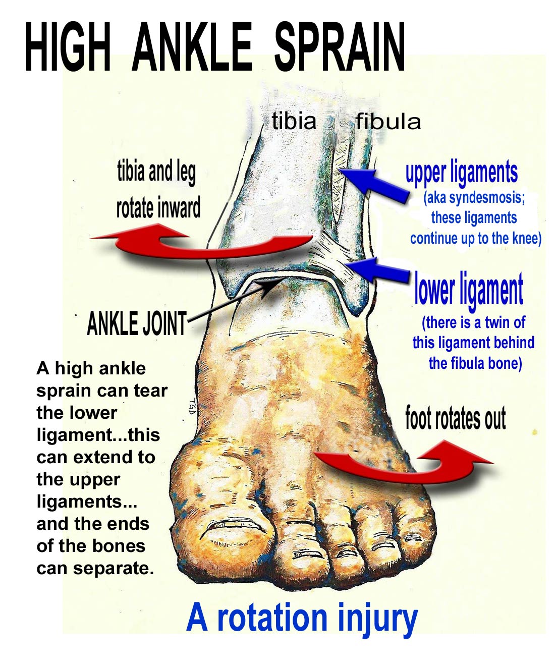 high ankle sprain, high injury ankle, upper ankle injury, treatment, symptoms ankle high sprain